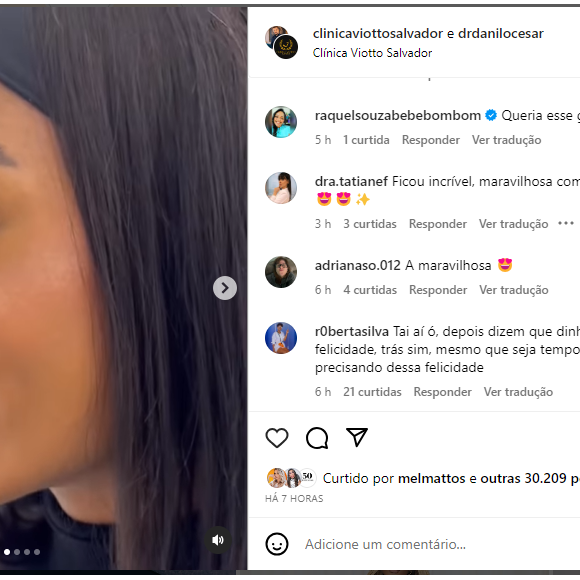 Brunna Gonçalves no Instagram foi elogiada por seu novo procedimento estético