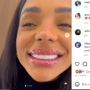 Brunna Gonçalves colocou lentes nos dentes e mostrou o resultado no seu Instagram