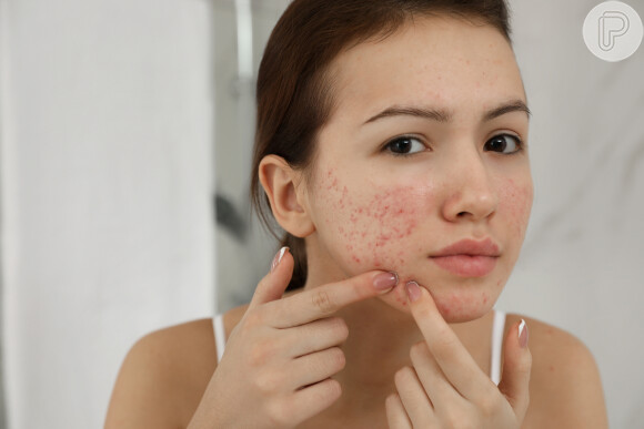 Verão causa mais acne? Por conta do calor, a produção e liberação de gordura pelas glândulas sebáceas tende a aumentar.
