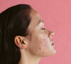 Quem tem tendência a ter acne na pele precisa tomar alguns cuidados especiais durante o verão