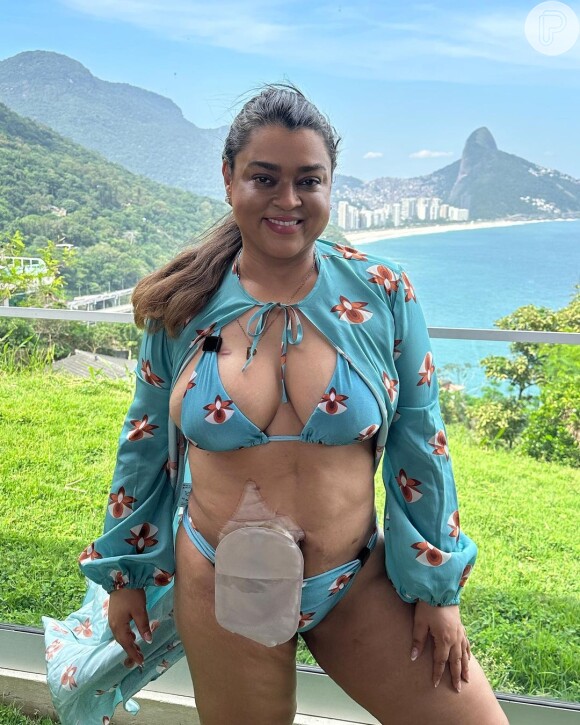 Preta Gil, após ser curada do câncer, mostrou nas redes sociais seu corpo real que agora tem uma bolsa ileostomia