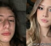 Influencer do TikTok de 14 anos faz plástica no nariz e choca com antes e depois de sua rinoplastia