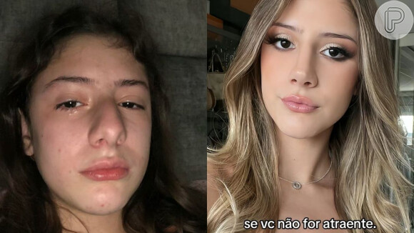 Influencer do TikTok de 14 anos faz plástica no nariz e choca com antes e depois de sua rinoplastia