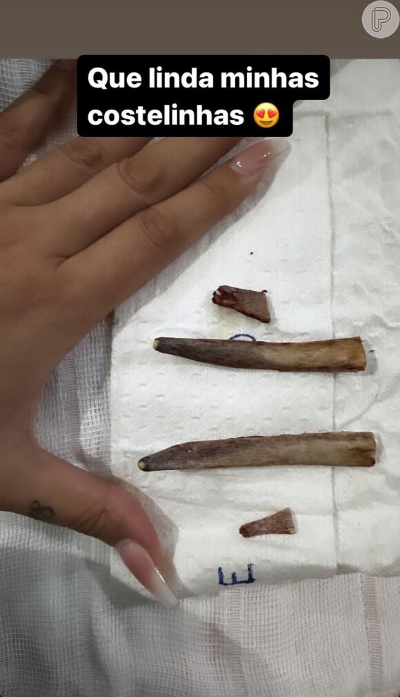 Andressa Urach chegou a mostrar os ossos retirados no procedimento e gerou polêmica na web