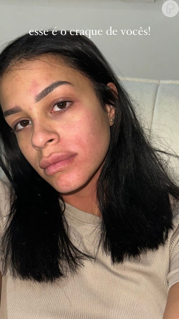 Ex-namorada de Kauê Rodrigues, Isabella Ribeiro mostrou rosto machucado, segundo ela, de agressões sofridas por parte do jogador: 'Quem acredita em mim, acredita. Quem não acredita, a Justiça vai provar'