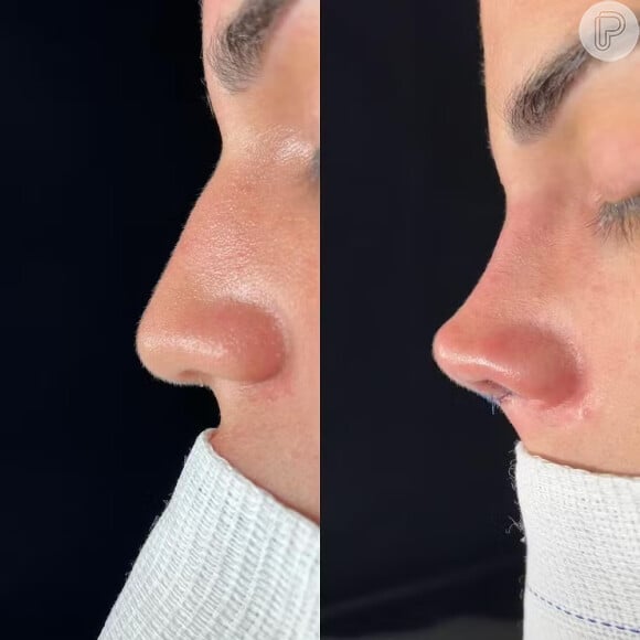 Antes e depois do nariz de Ray Marcelle impressiona; rinoplastia durou quatro horas