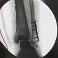 Fabio Assunção usou as redes sociais para mostrar a cirurgia realizada em seu pé esquerdo