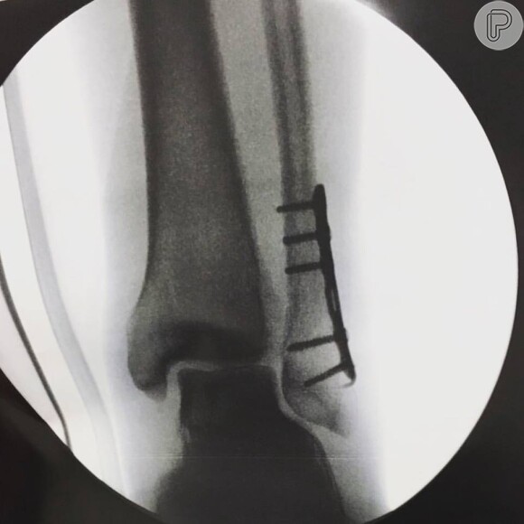 Fabio Assunção usou as redes sociais para mostrar a cirurgia realizada em seu pé esquerdo