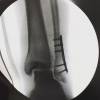 O ator compartilhou com os fãs uma foto do raio-X do seu pé após a cirurgia na quarta-feira, 09 de março de 2016