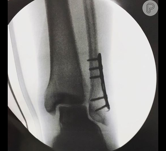 O ator compartilhou com os fãs uma foto do raio-X do seu pé após a cirurgia na quarta-feira, 09 de março de 2016