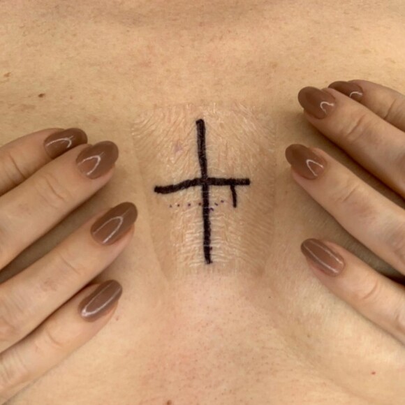 Ana Furtado mostra marca de radioterapia: 'Vejo sinal de positivo'