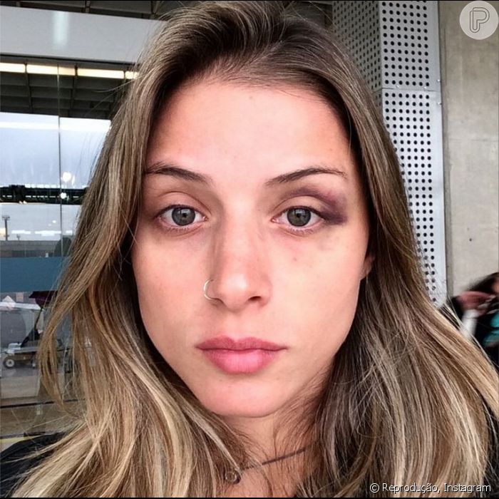 Em seu Instagram, Angela Sousa mostrou uma foto dos hematomas em seu rosto que, segundo ela, foram provocados por Yuri Fernandes