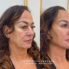 Mãe de Neymar, Nadine Gonçalves surpreende com antes e depois de harmonização facial na clínia JK Estética Avançada, em São Paulo