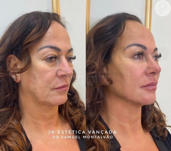 Mãe de Neymar, Nadine Gonçalves surpreende com antes e depois de harmonização facial na clínia JK Estética Avançada, em São Paulo