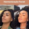 Mulher de Ludmilla, Brunna Gonçalves fez harmonização facial