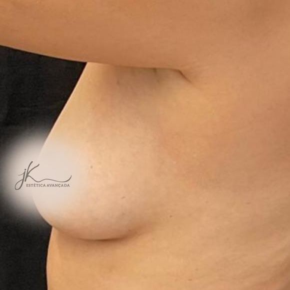 Sarah Andrade realizou o sonho de colocar silicone nos seios