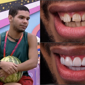 Vinícius, fora do 'BBB 22', coloca lente de contato nos dentes e renova sorriso