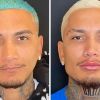 Antes e depois dos procedimentos de hamorização facial de Dynho Alves