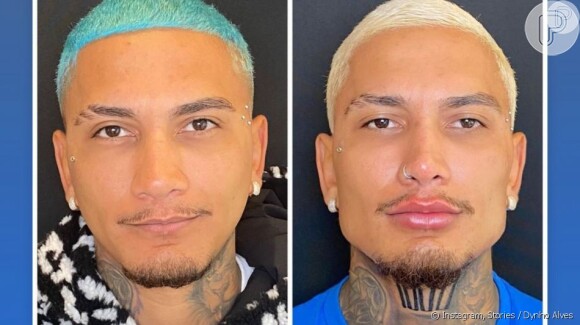 Antes e depois dos procedimentos de hamorização facial de Dynho Alves