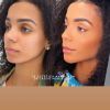 Antes e depois da hamorização facial de Bruna Gomes