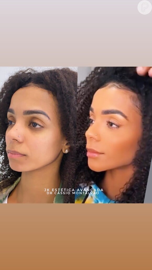 Antes e depois da hamorização facial de Bruna Gomes