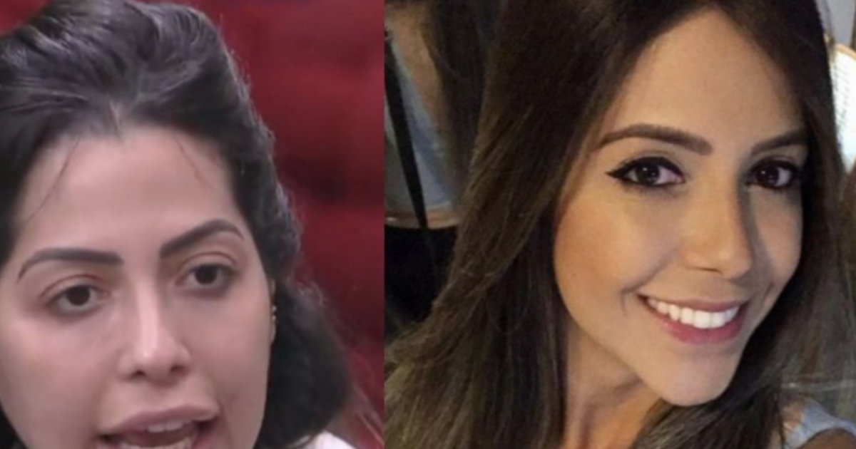 Veja o antes e depois da harmonização facial de Laís Caldas Purepeople