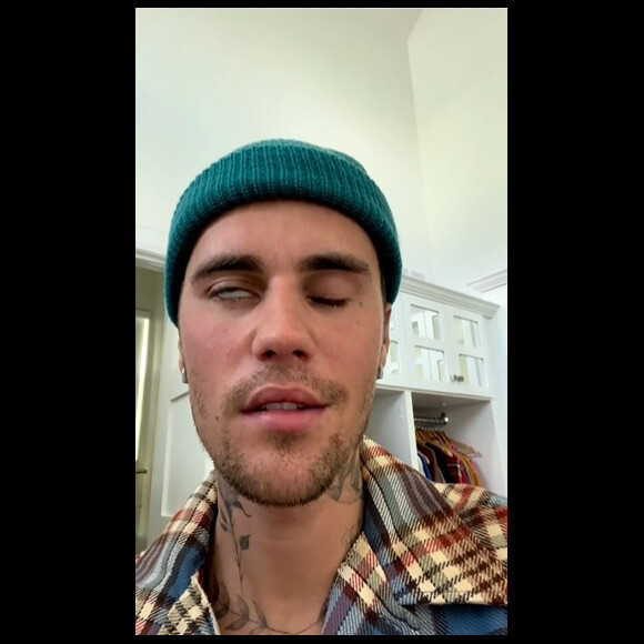 Olho, nariz e boca de Justin Bieber estão paralisados por causa da síndrome