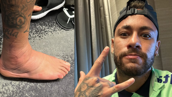 Neymar Jr mostra pé machucado durante jogo do Brasil e revela evolução no tratamento. Veja!