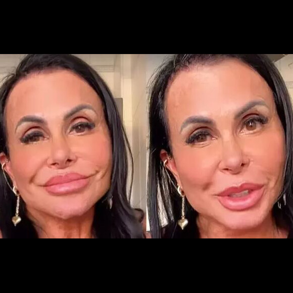 Gretchen foi comparda a um pato ao mostrar resultado de harmonização facial e rebateu: 'A cara é de quem?''