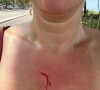 Natasha Dantas teve um ferimento por conta da forma abrupta que o cordão foi arrancado: 'Está na mão de um meliante'