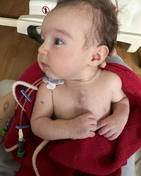 Filha de Thaila Ayala e Renato Góes ficou com cicatriz no peito após passar por cirurgia cardíaca