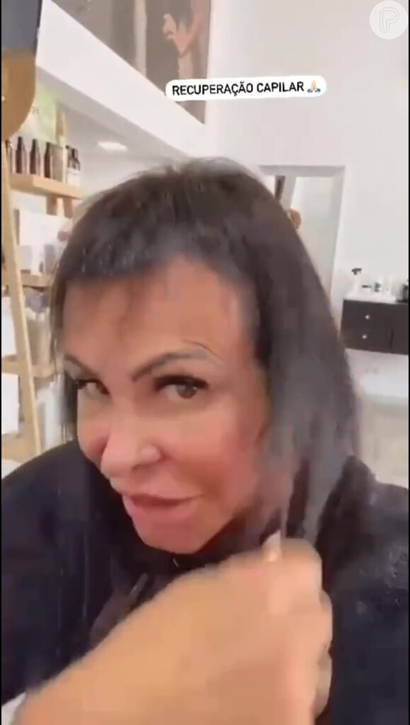 Gretchen foi submetida a um tratamento de Microinfusão de Medicamentos na Pele (MMP), com a aplicação subcutânea de substâncias para ajudar o cabelo a crescer