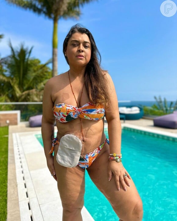 Preta Gil deixou bolsa de ileostomia à mostra em novas fotos 