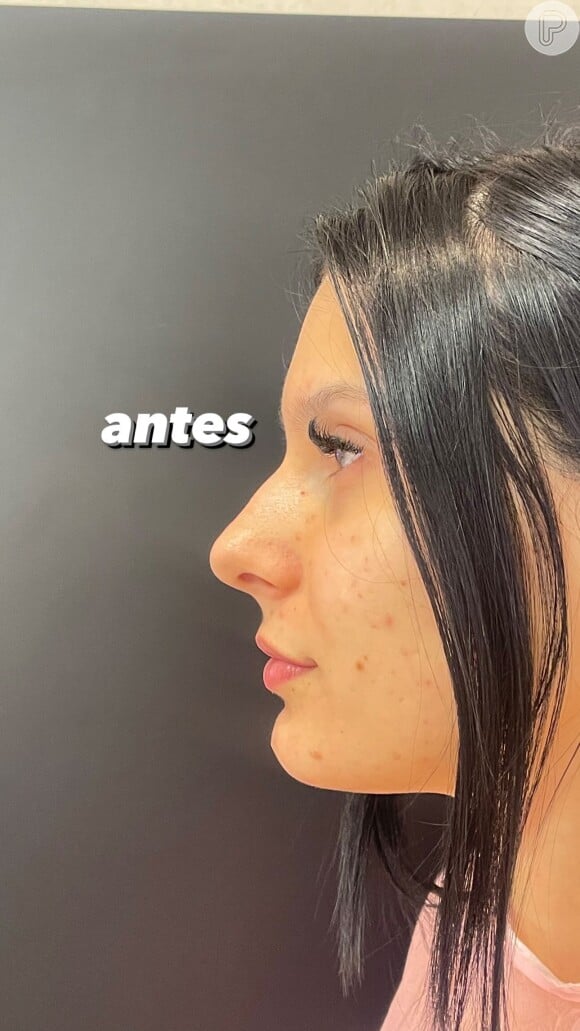 Novo nariz de Ana Castela: 'Boiadeira' passou por rinomodelação em clínica de estética em novembro de 2023