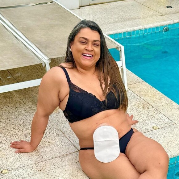 A cicatriz na barriga de Preta Gil é por causa da bolsa de ileostomia, usada na reta final do tratamento