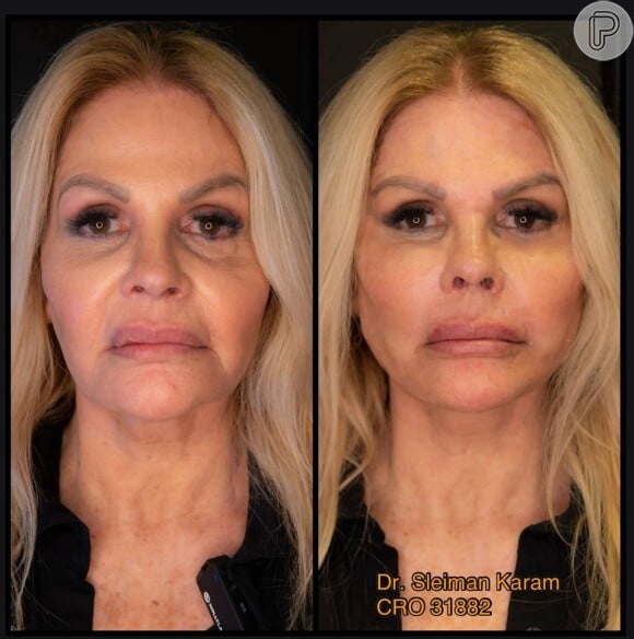 Monique Evans mostrou o resultado de uma harmonização facial em seu Instagram