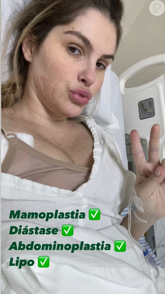 Bárbara Evans realizou um 'combo' de cirurgias há 17 dias, que incluíram lipo na barriga, enxertia no bumbum e até lipo nas axilas