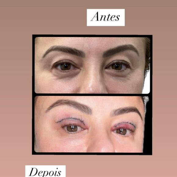 Poliana Rocha impressionou ao revelar o seu antes e depois da blefaroplastia, que ainda está em cicatrização