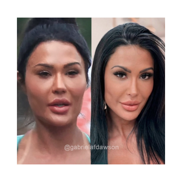 Buscando naturalizar seu rosto, Gracyanne Barbosa removeu alguns preenchedores nos últimos dias