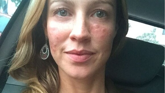 Luana Piovani exibe rosto inchado em foto: 'Depois de ter queimado as sardas'