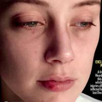Amber Heard, ex-mulher de Johnny Depp, surge com rosto machucado em novas fotos