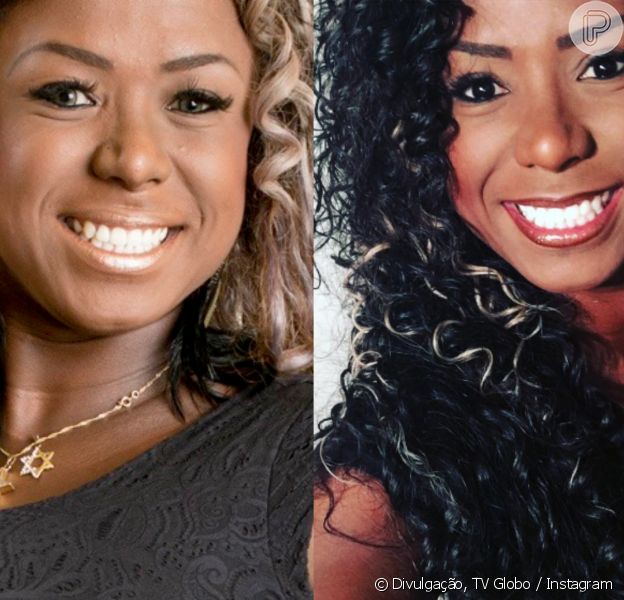 bichectomia antes e depois rosto redondo