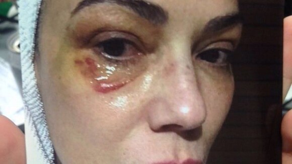 Luiza Brunet aparece com olho roxo em foto após agressão: 'Cuidando das marcas'