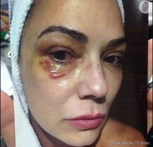 como tratar hematoma no olho