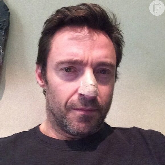 Recentemente, Hugh Jackman usou a sua conta no Instagram para revelar aos seus fãs que estava se submetendo a um tratamento para câncer de pele. O ator publicou uma foto onde aparece com um curativo no nariz após se submeter a um procedimento