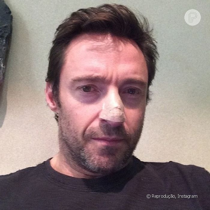 Recentemente, Hugh Jackman usou a sua conta no Instagram para revelar aos seus fãs que estava se submetendo a um tratamento para câncer de pele. O ator publicou uma foto onde aparece com um curativo no nariz após se submeter a um procedimento