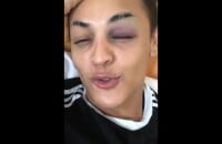 Pabllo Vittar se acidenta com joelhada no rosto como explicou em vídeo nesta quarta-feira, dia 25 de julho de 2018