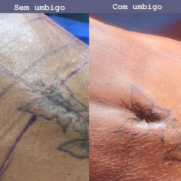 Gretchen teve o umbigo reconstruído