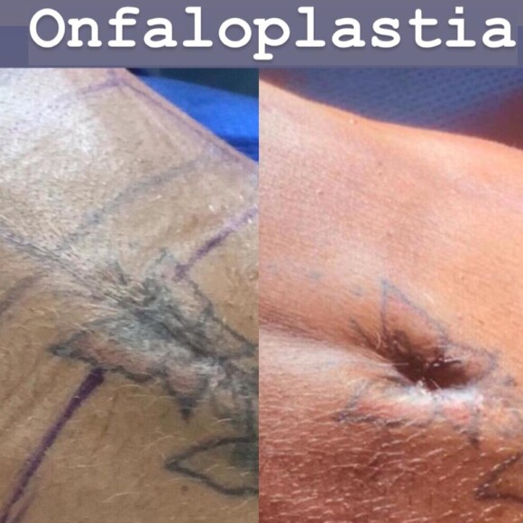 Gretchen contou como lida com intervenções estéticas