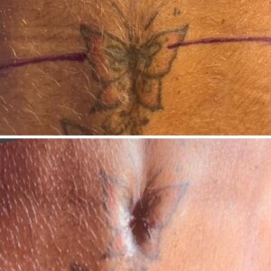 Operação fez com que Gretchen tivesse o umbigo reconstruído